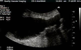 Abdominal Aortic Aneurysm – Sonographic Tendencies