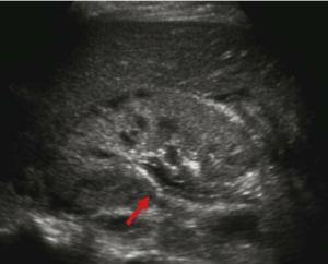 fig-8-grayscale-ultrasound-images-of-the-renal-pelvis-demonstrate-urothelial-thickening