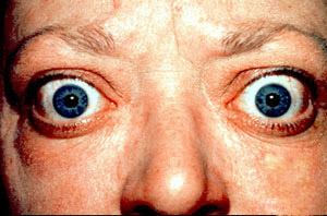 proptosis_and_lid_retraction_from_graves_disease