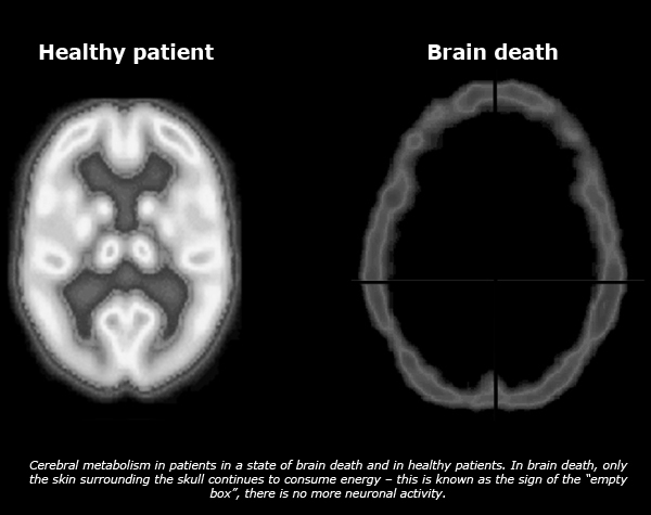 brain_death