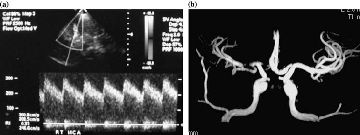 Fig-2-A-9-year-old-child-with-SCD-a-TCD-demonstrates-abnormal-right-MCA-time-average