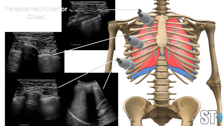Chest and Lung Ultrasound – Sonographic Tendencies