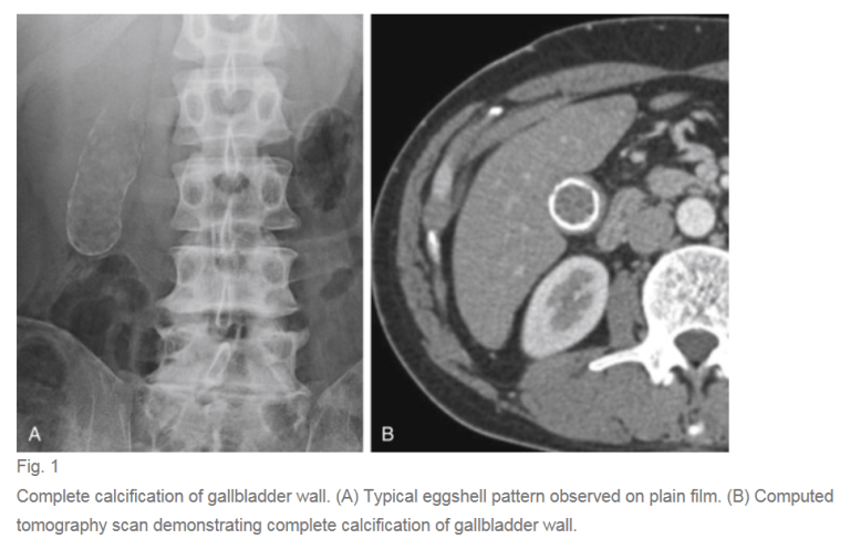 Gallbladder Calcium Gallbladder and Biliary Pathology – Sonographic Tendencies