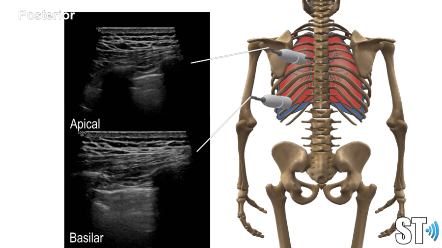 Chest and Lung Ultrasound – Sonographic Tendencies
