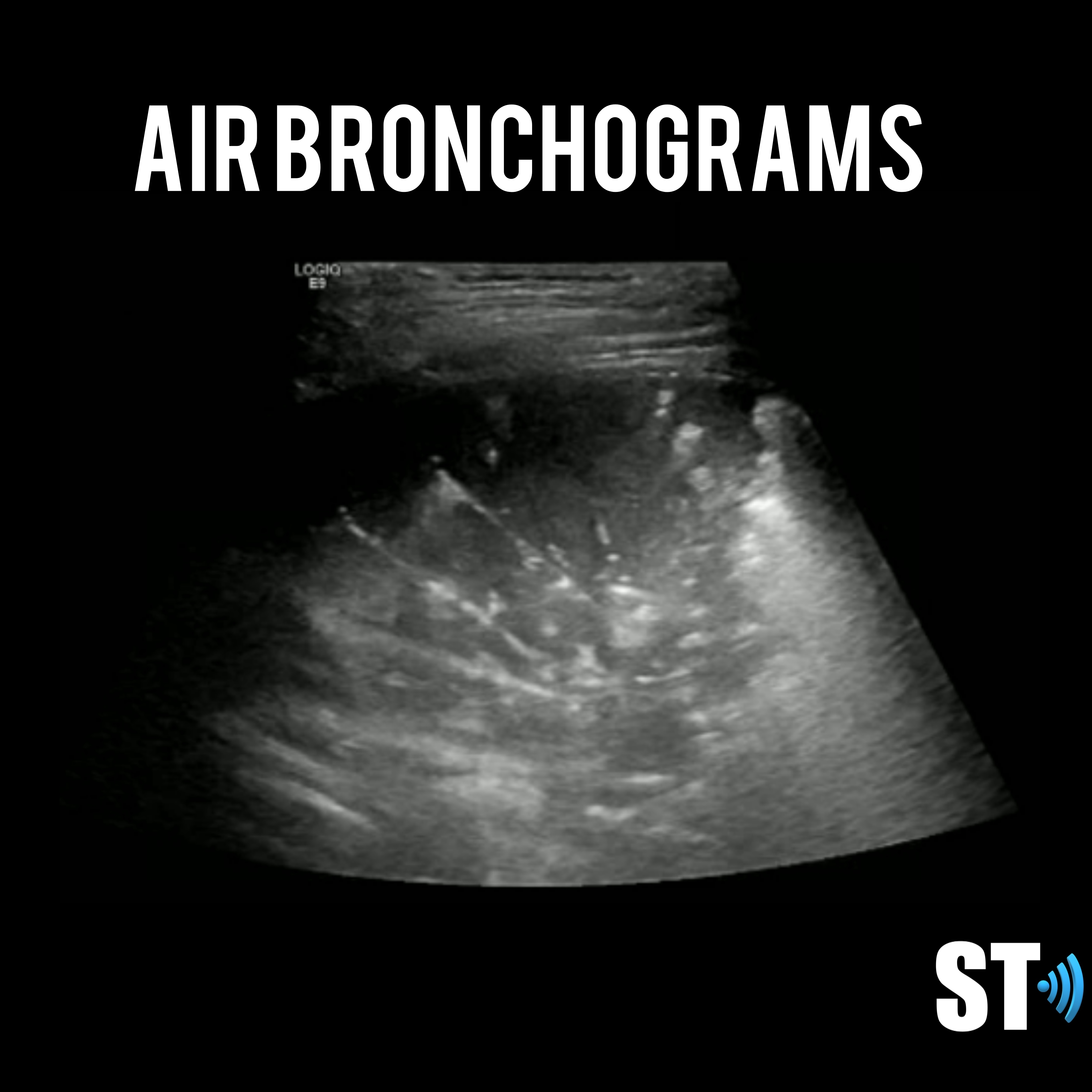 Chest and Lung Ultrasound – Sonographic Tendencies