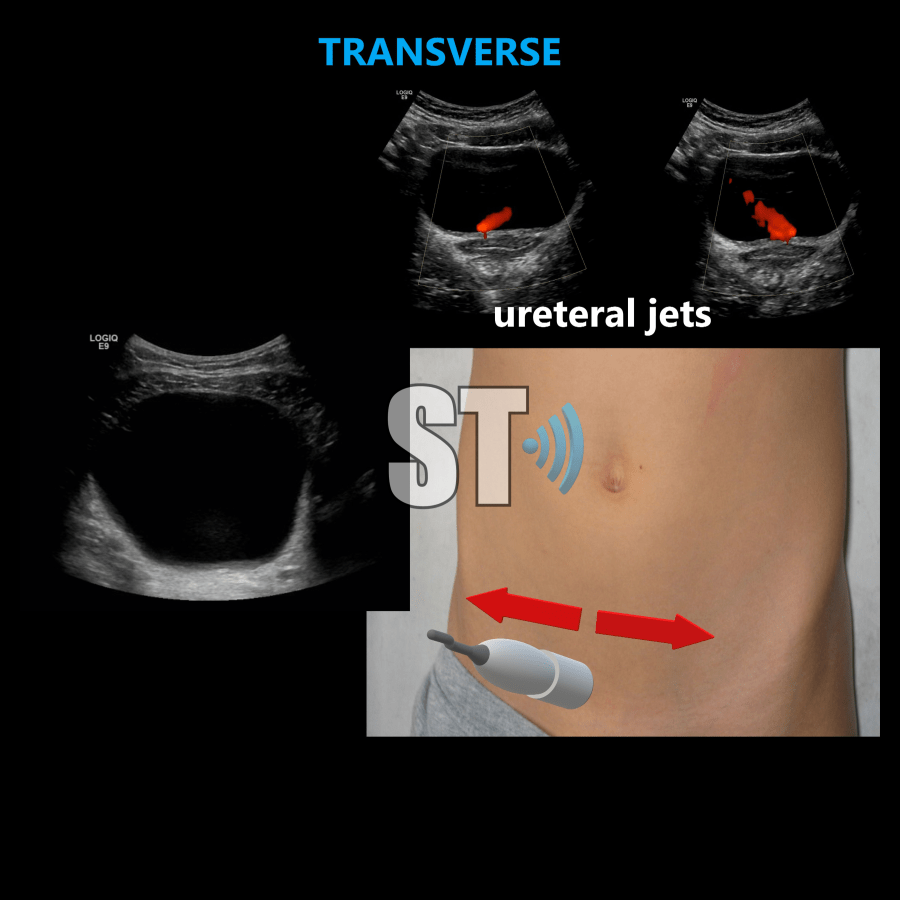Renal Ultrasound Complete Protocol – Sonographic Tendencies