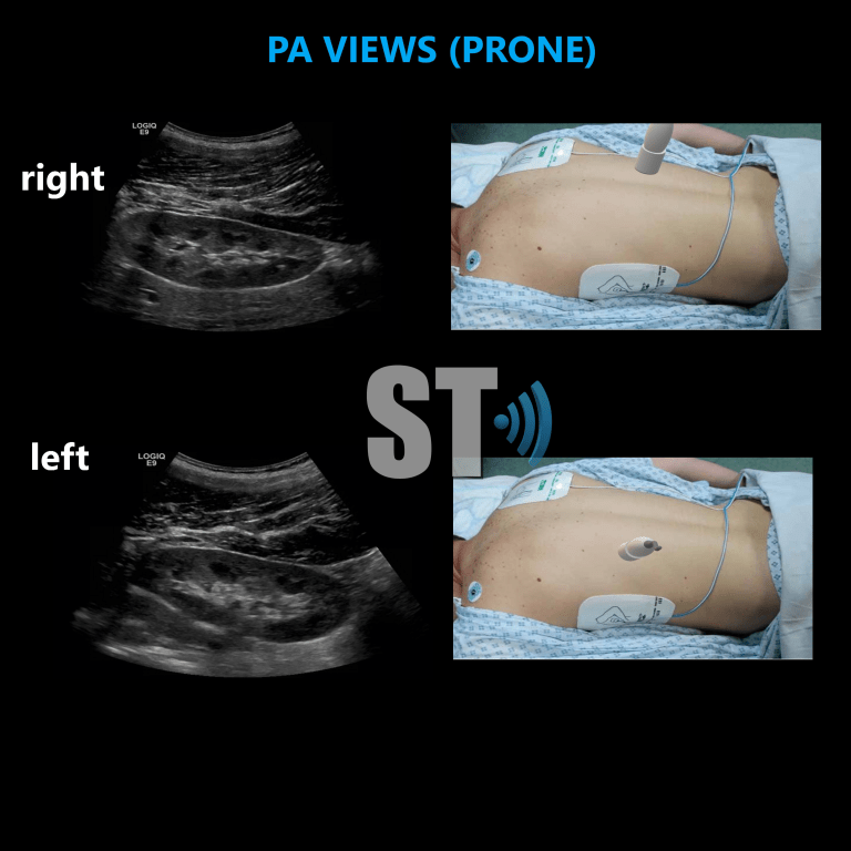 Renal Ultrasound Complete Protocol – Sonographic Tendencies