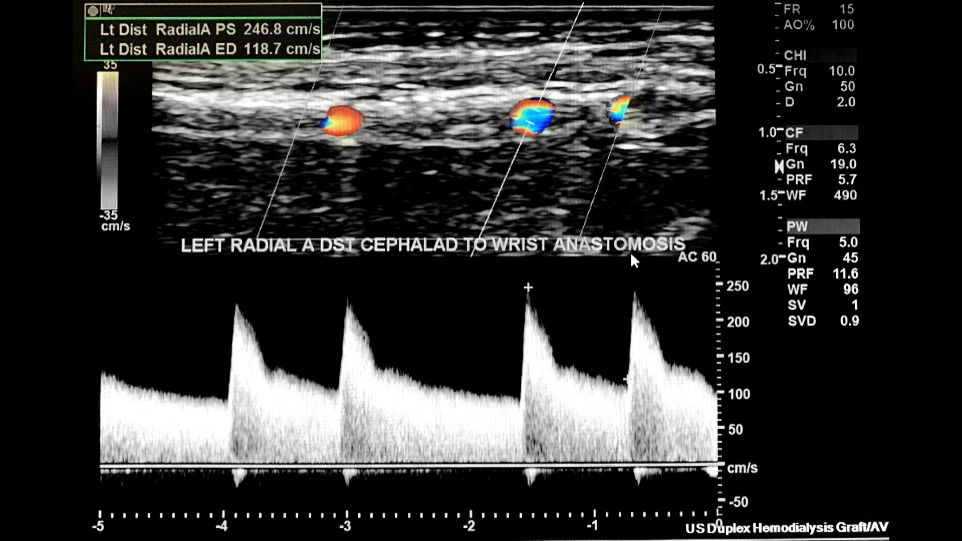 Hemodialysis Vascular Access – Sonographic Tendencies