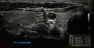 Thyroid Size Ultrasound KJR Korean Journal Of Radiology Thyroid Size Ultrasound KJR Korean Journal Of Radiology
