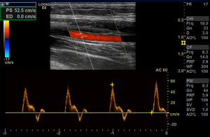 Hemodialysis Vascular Access – Sonographic Tendencies