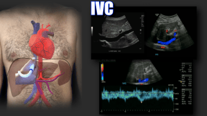 Portal Vein Doppler – Sonographic Tendencies