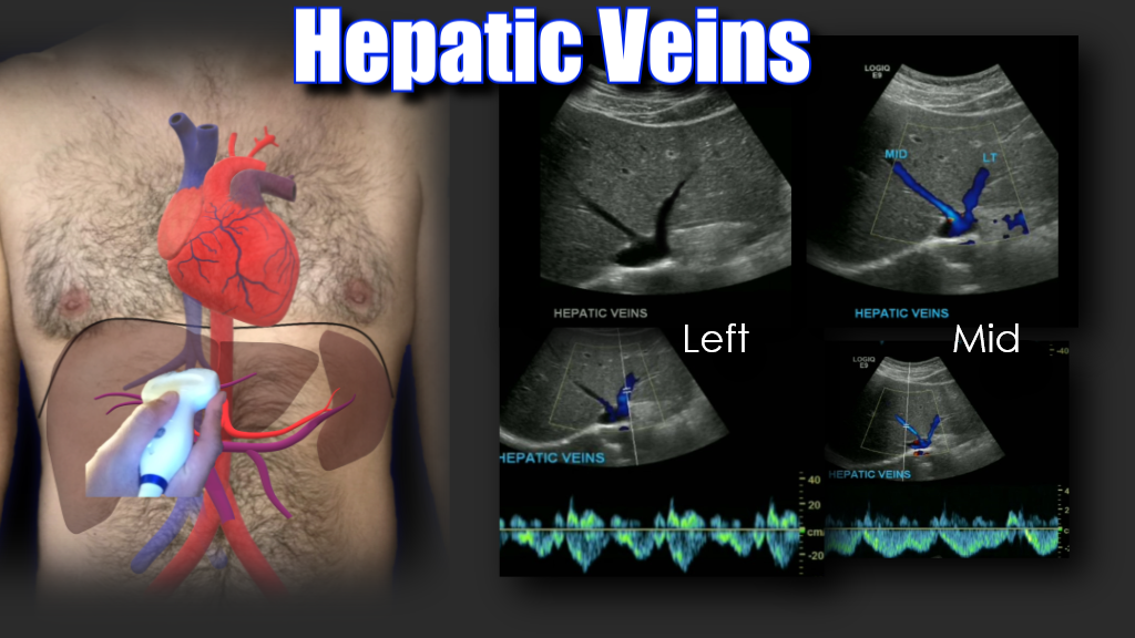 Portal Vein Doppler – Sonographic Tendencies