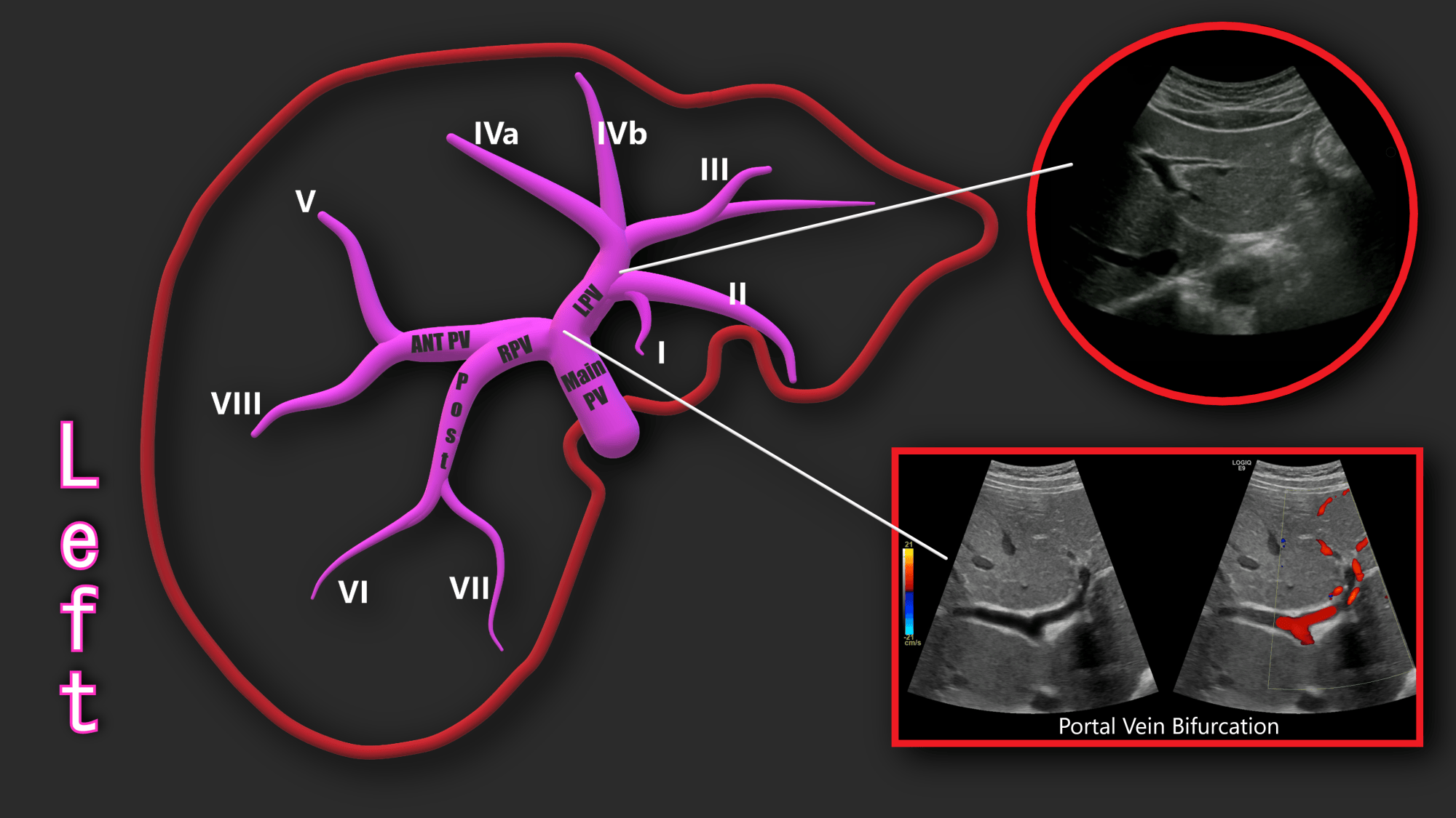 Portal Vein Doppler – Sonographic Tendencies