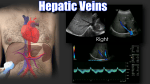 Portal Vein Doppler – Sonographic Tendencies