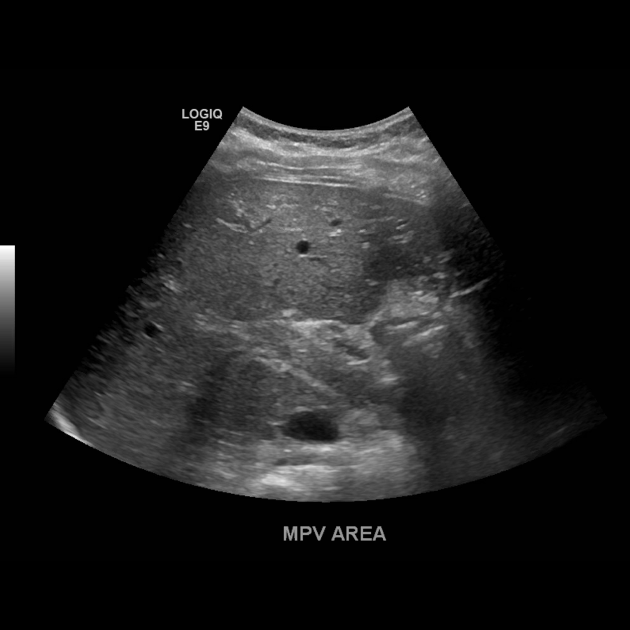 Portal Vein Doppler – Sonographic Tendencies